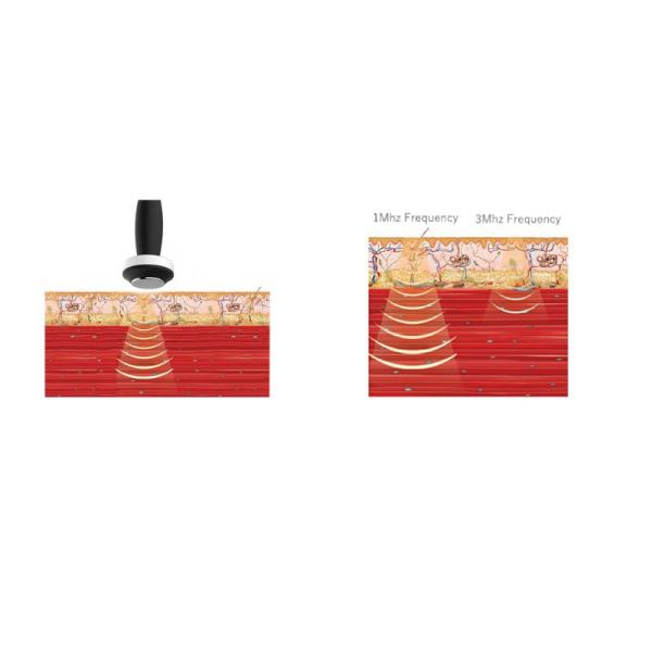 Dispositivo de terapia ultrasónica Gomecy para rehabilitación clínica y aplicaciones domésticas para el alivio del dolor