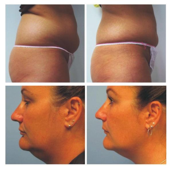 High Intensity Focused Ultrasound HIFU Equipment For Body Slimming / Face Lifting