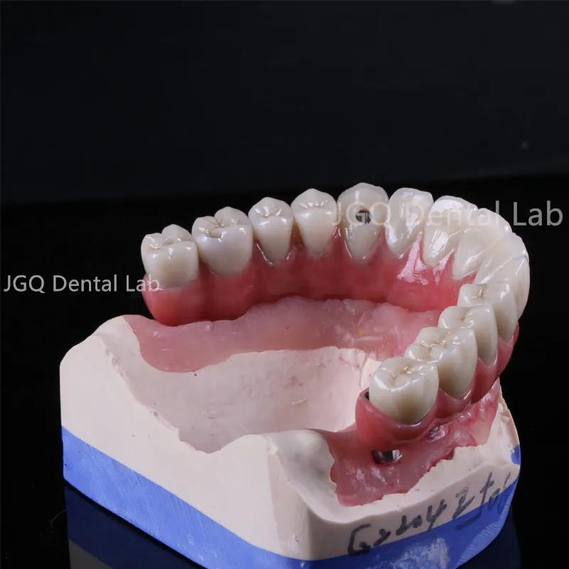 Ball-Cap Implant Overdenture Offers Excellent Stability and Retention Suitable for Elderly Patients Lab Prices