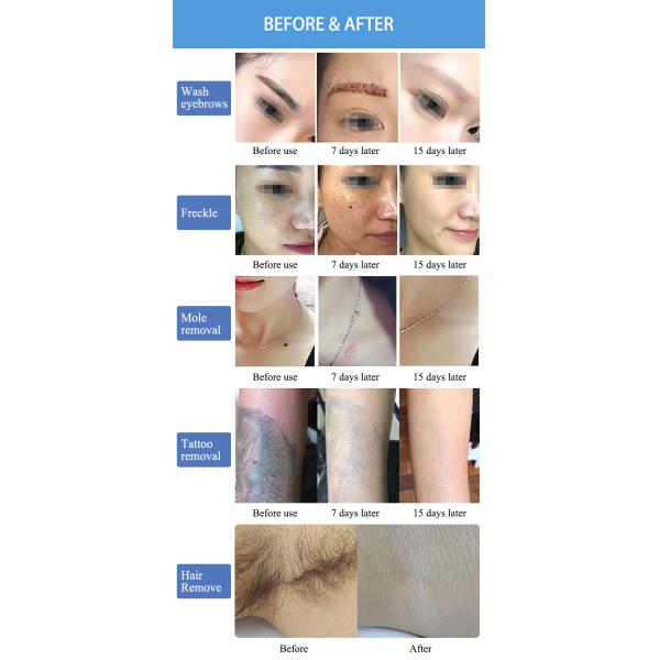 2 In 1 ND Yag Laser Tattoo Removal Machine 755nm 532nm 1064nm Diode