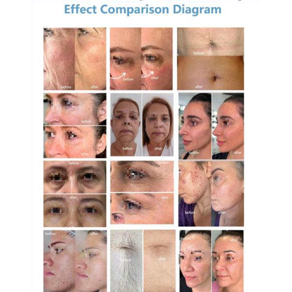 Ozone Wart Cold Spray Pen Skin Rejuvenation Latest Plasma Pen