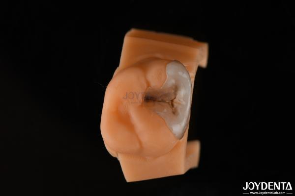 Custom Compound Inlay Onlay For Minimally Invasive Dental Restoration