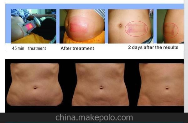 OEM & ODM available Radio frequency cavitation vucuum fat freeze coolsculpting