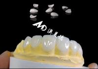 Translucidez IPS Emax Veneers, Preparação mínima Emax Veneers Dental