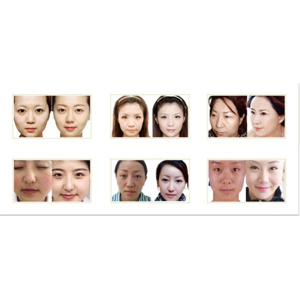 2000W SHR Hair Removal Machine YAG Laser IPL Beauty Machine