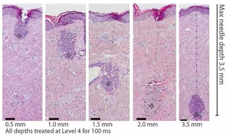 New Arrivals! Micro ultra Face Lift Scarlet RF Needle Machine Fractional RF Microneedle