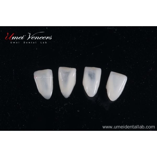 Customized ultra-thin dental veneer