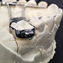 3D Printing Minimal Prep Orthodontic Arch Expander For Teenager