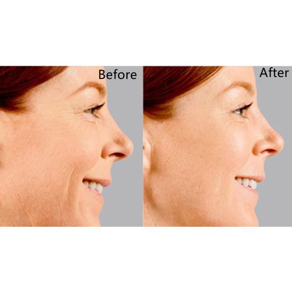 Injectable Dermal Filler Juvederm Voluma Anti Wrinkles For Cheek