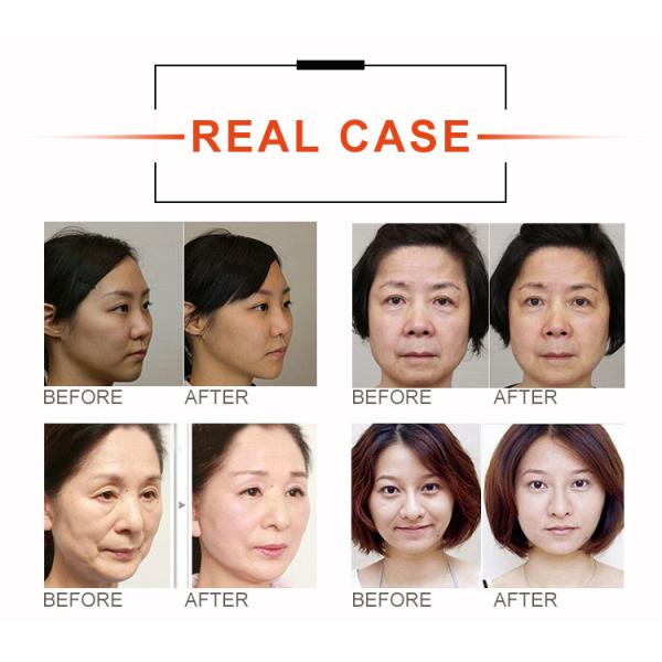 Профессиональная неинвазивная портативная машина для ухода за кожей