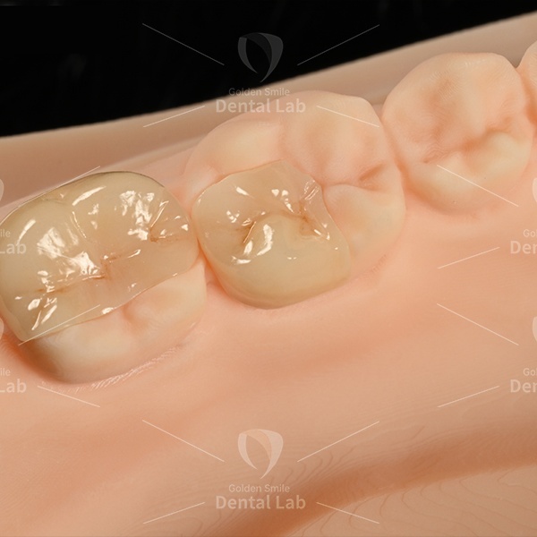 High Strength Zirconia Inlay Onlay Zirconia Restorations CAD / CAM Digital Milling