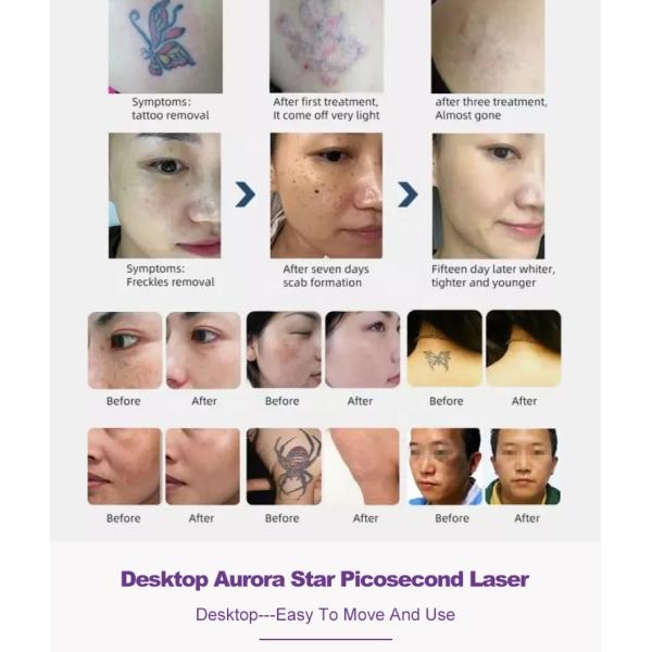 Laser Beauty Equipment Professional Pico Picosecond Machine Q Switched Nd Yag Laser Tattoo Removal Machine