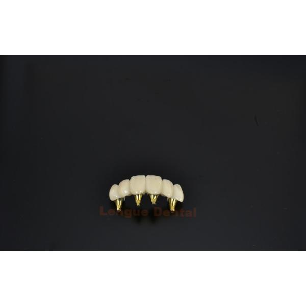 Customized Titanium Dental Implant Denture Crown Revitalize Your Smile