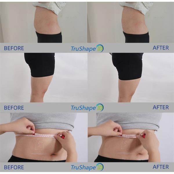 Monopolar Rf Beauty Equipment Non Invasive Trueshape Body Sculpting Trusculpt Id
