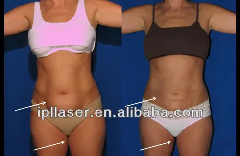 HIFU Liposonix 2 in 1 Beauty Machine for face lifting and shaping / slimming