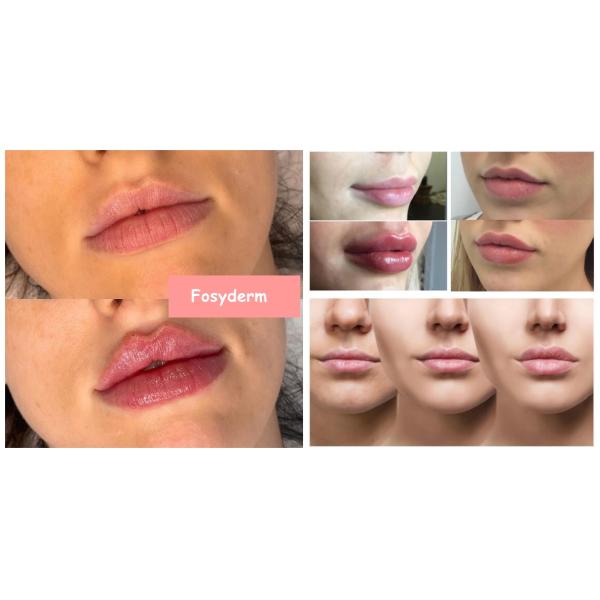 дермальный крест 2ml соединил Hyaluronic заполнители ручки