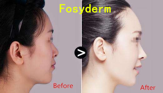 Заполнитель носа впрыски Хялуроник кислоты дермальный, заполнители геля Хялуроник кислоты