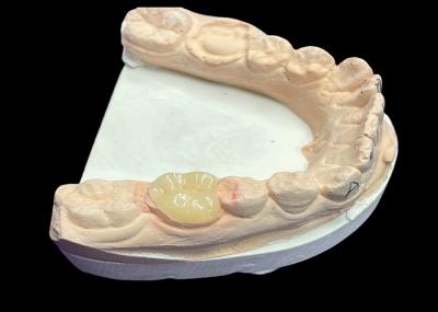 Dentária de inserção de cerâmica suave personalizada resistente à coloração de dentes Reparação de dentes sem costura