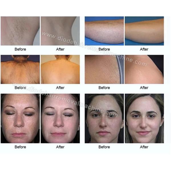 500 Thousand Shots Opt Shr Hair Removal Machine Multi Function Beauty Equipment