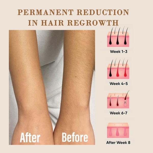 Medical Grade Titanium Diode Laser Hair Removal Machine 4 Waves