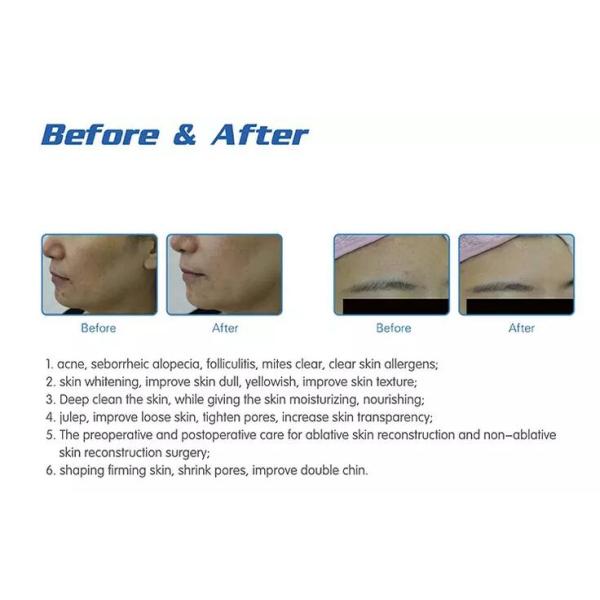 Professional Universal Ultrasonic Water Hydra Facial Machines With 6 Handles