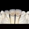 Dental Alloy Metal Ceramic Crown Dental Restoration Porcelain Fused Metal Teeth