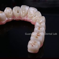 All On 6 Dental Implants Fixed Dentures Dental Lab All Ceramic FDA CE Certificated