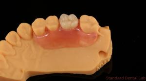 Dental TCS Valplast Flexible Partial Dentures Nesbit Valplast Finish China