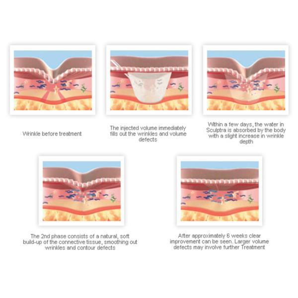 5 мл кожных наполнителей для лица PLLA коллаген Derma Filler для инъекций