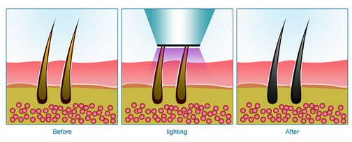 Pain Free 300W 808nm Diode Laser Hair Removal Machine Micro Cooling System