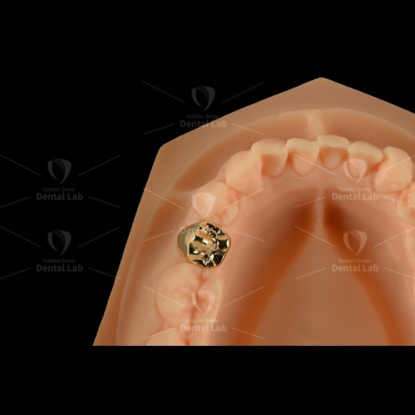 Yellow Gold 62% Full Cast Crown Saliva And Acids Resistant Gold Crown Implant