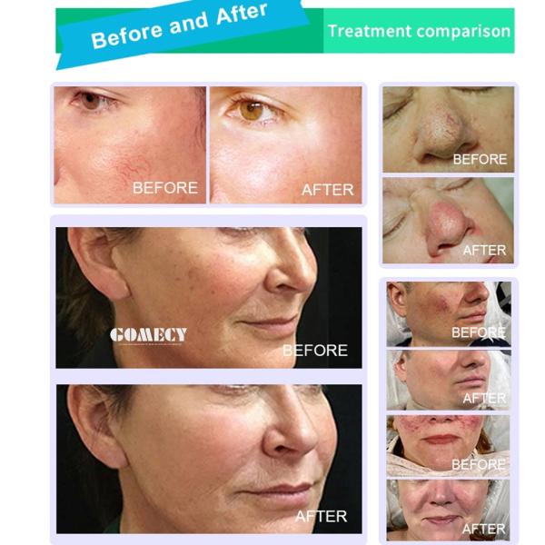 Диодная лазерная терапия 1470nm 980nm хирургическая липосакция