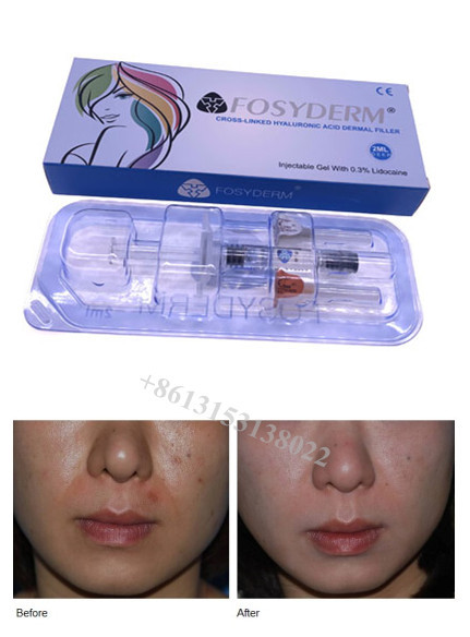 Hyaluronic кисловочный заполнитель геля дермальный для губ сморщивает заполнитель