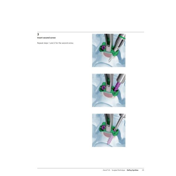 Sterilization 2 Screws Zero Profile Cage Anterior Cervical Cage Stand Alone CE Spinal Surgery