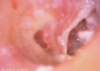 Grupo video do Otoscope de Digitas para o diagnóstico da orelha e a perfuração contaminados do cilindro de orelha