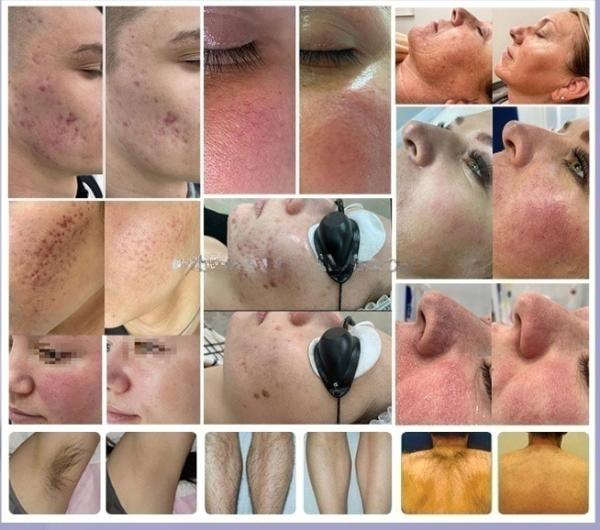 M22 IPL Laser Beauty Equipment Nd Yag Tattoo Removal and Hair Removal Skin Rejuvenation Machine for Skin Discolor