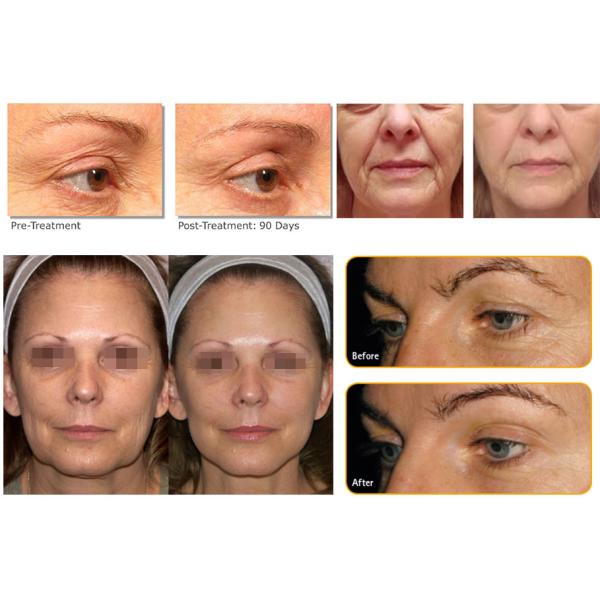 2015 Newest HIFU skin tightening Beauty Equipment 