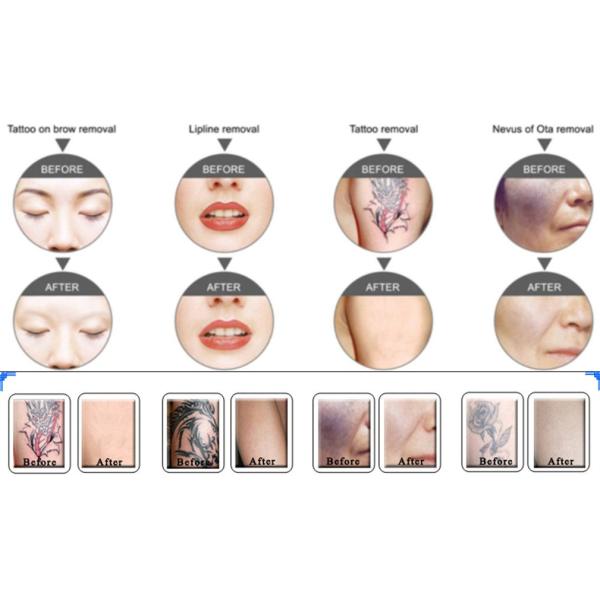 Переносная Nd YAG лазерная машина 532nm 1064nm Carbon Peel Laser Machine Удаление татуировок