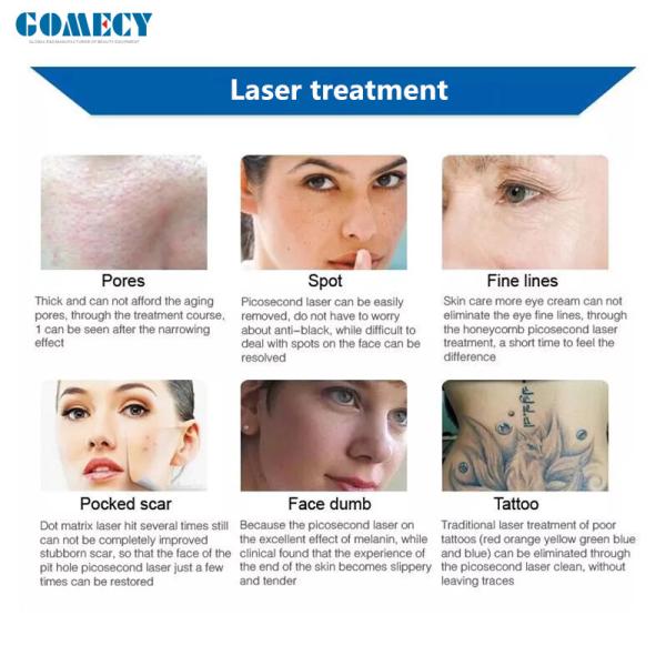 Popular Nd Yag Tattoo Removal Laser Machine For Skin Whitening