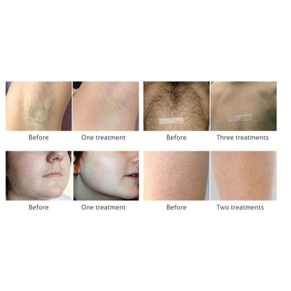 Painless 808nm Diode Laser Hair Removal Machine Vertical Type For Any Skin Color