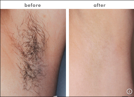 2 in 1 IPL Hair Removal Machines Effective For skin rejuvenation and hair removal