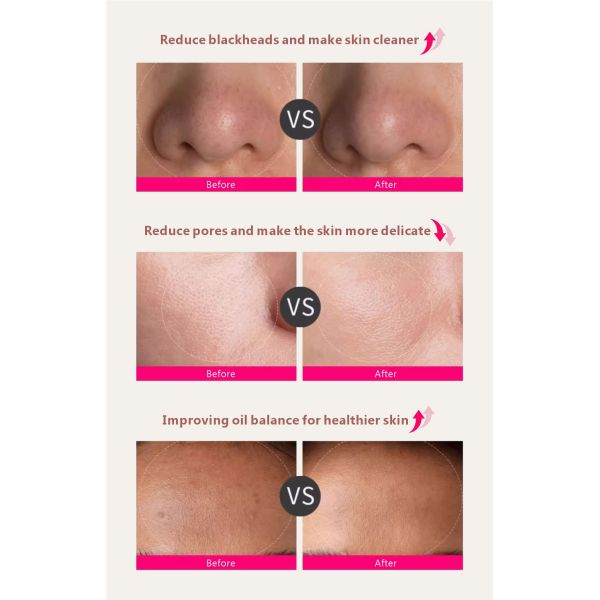 Mini Vacuum Blackhead Remover Pore Cleaner Deeply Extracts Dirt And Oil From Pores Helps Improve Enlarged Pores