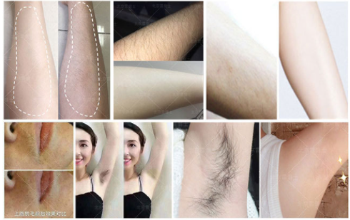 810nm 808 Nm Laser Diode Semiconductor Cool Chips 10 Million Shots