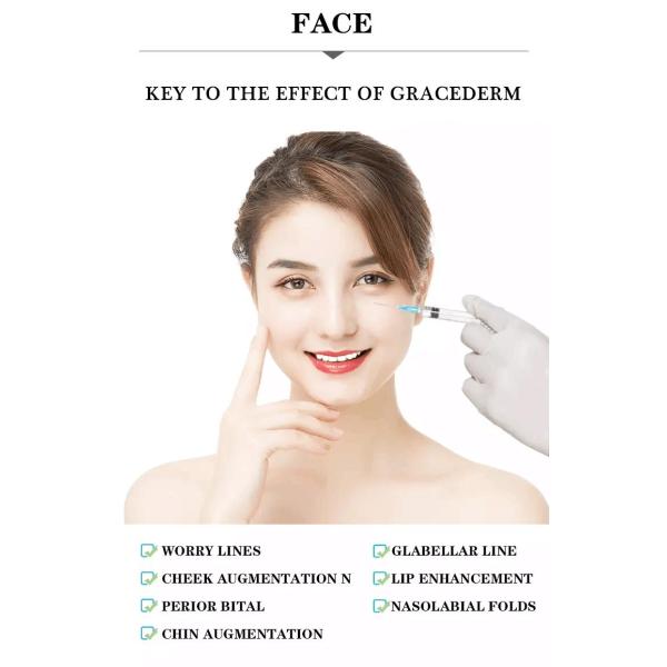 Long Lasting Neuramis Dermal Filler For Wrinkle Reduction With Redness/Swelling/Bruising Side Effects