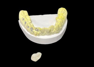 Solução restaurativa Onlay Dental Ceramic Inlay sob medida Reparação de dentes danificados