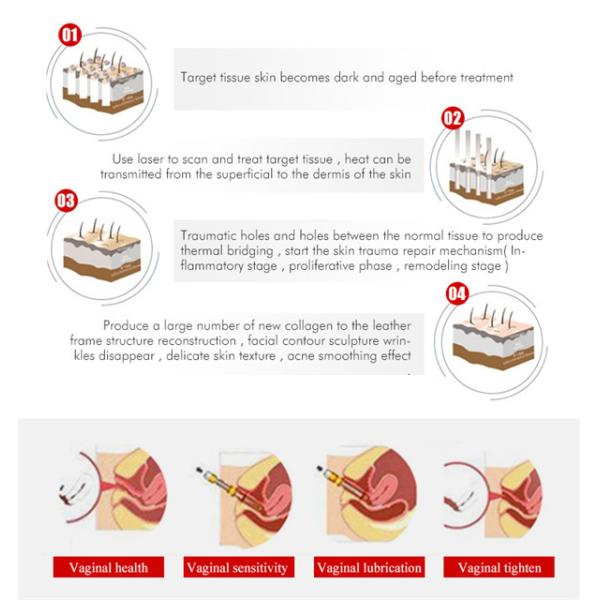машина лазера СО2 635nm для обработки 110V-250V пор кожи большой