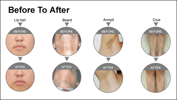 Painless SHR ELight Hair Removal Machine RF Radio Frequency Skin Tightening Machine