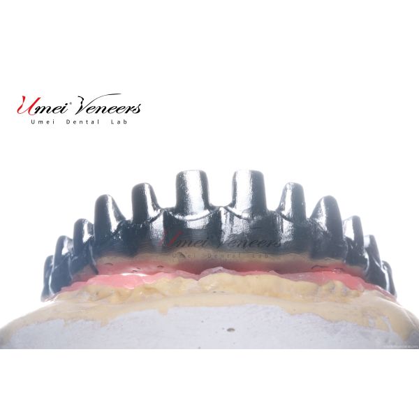 Robust Zirconia Malo Bridge