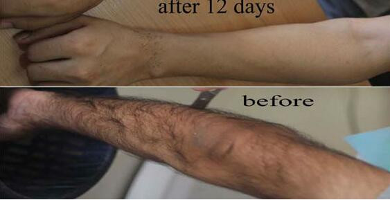 Portable 800-810nm wavelength 808 diode laser machine for hair removal