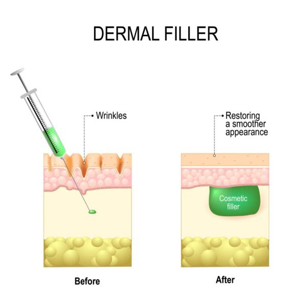 Face Lip Crosslinked Dermal Filler Juvederm Ultra3 Hyaluronic Acid Gel